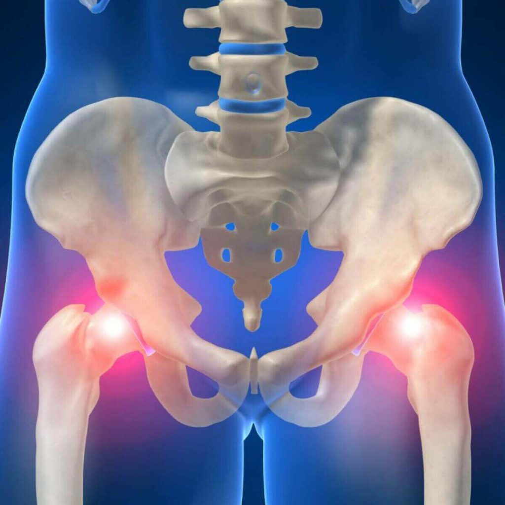 Apatinės nugaros skausmas praeina - Osteochondrozė - 