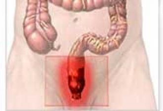 Proctita intestinală: simptome și tratament la adulți Tratamentul proctitei în timpul menstruației