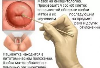गर्भाशय ग्रीवा के कटाव को शांत करने से पहले परीक्षण गर्भाशय ग्रीवा के कटाव को शांत करने के लिए किन परीक्षणों की आवश्यकता होती है