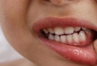 علاج التهاب الفم لدى البالغين في المنزل: علاجات للمرض كيف يمكنك علاج التهاب الفم في المنزل